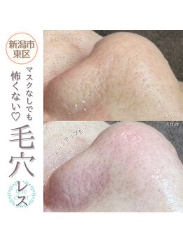 ソマリ(SOMALI)/【毛穴洗浄&ヒト幹導入】