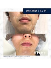 メンズクリア 秋田OPA店/【メンズクリア】お客様の施術例