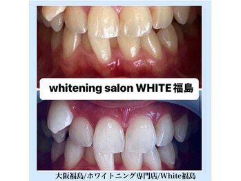 ホワイトニングサロン ホワイト(WHITE)/セルフホワイトニング/大阪/福島