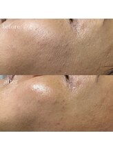 リメレ(Rimere)/シワ改善