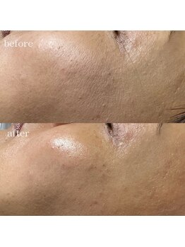 リメレ(Rimere)/シワ改善