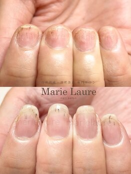 マリーロール 淀屋橋本店(Marie Laure)/自爪育成/深爪矯正/ネイルケア