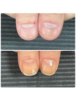 ウェルズユキ(well's yuki)/爪に割れ目が入ってくる