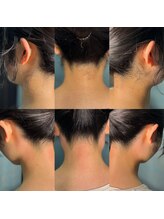 シュシュ 梅田店(+Chou chou)/うなじ脱毛