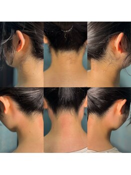 シュシュ 梅田店(+Chou chou)/うなじ脱毛