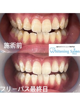 ホワイトニングサロン 熊本店/熊本市でホワイトニング