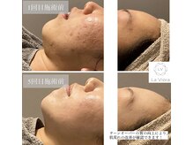 ラヴィオーラ 明石店(La Viora)/ダイヤモンドハーブピーリング