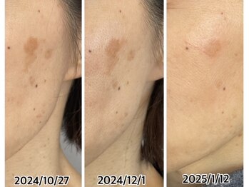 アップル 宇都宮店(Apple.)/肌質改善プログラム