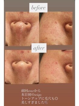 フットミー(foot mii)/リフティング、タイトニング