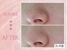 クリアラボ 池袋2nd(Clear Lab)/韓国肌管理&毛穴洗浄専門店