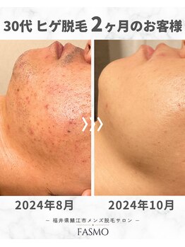 ファスモ(FASMO)/30代 / ヒゲ脱毛 / 2ヶ月目