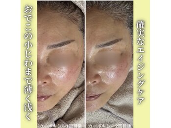 ハニエル(Haniel)/カーボキシー症例