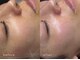 ブルーム(bloom.)の写真/【お肌の"かかりつけ"サロン】一人ひとりのお悩みに合わせたカスタムケアで本気の根本肌質改善◎