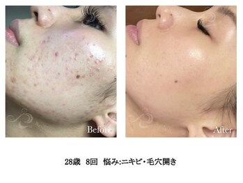 ハーバリー ハーブピーリング 岐阜(HERBERRYハーブピーリング)/ハーブピーリング専門店HERBERRY