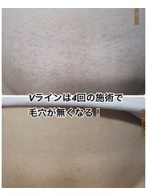 美容脱毛専門サロン エピラージュ 新宿店(Epilage)/Vラインは減りが早い