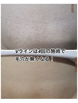 美容脱毛専門サロン エピラージュ 新宿店(Epilage)/Vラインは減りが早い