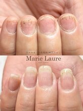 マリーロール 淀屋橋本店(Marie Laure)/自爪育成/深爪矯正/ネイルケア