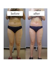 アップルミント/＜痩身＞before・after