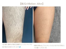 ステラ(STELLA)/足脱毛　Before After