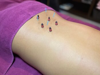 アミナス美容鍼灸(AMINAS美容鍼灸)/腰・お灸