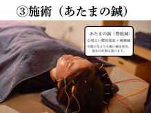 シゴウ鍼灸整体院(Shigo鍼灸整体院)/施術（頭の鍼）