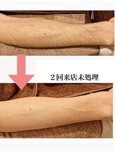 ベリール バイ ラスティ(Belile by LUSTY)/部分脱毛【腕】