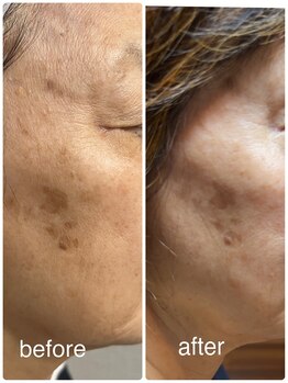 ビーアンドビー(B&B)/エクソソーム美肌コース