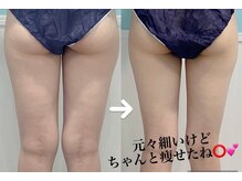 ビーナスアイスブルー(Venus ICE BLUE)/脂肪冷却