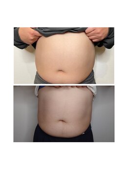 プルメリア(Plumeria)/痩身☆お客様経過写真