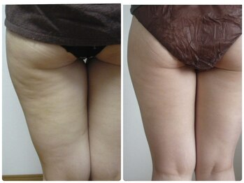 エルブラン(Herb ame)/美脚/脂肪分解