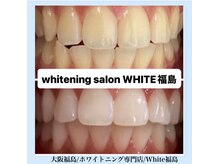 ホワイトニングサロン ホワイト(WHITE)/セルフホワイトニング/大阪/福島