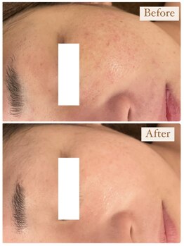 ミラ(Mila)/肌質改善BeforeAfter☆