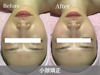 トウメイコガオ 横浜店/トウメイコガオで小顔エステ