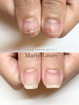 マリーロール 淀屋橋本店(Marie Laure)/自爪育成/深爪矯正/ネイルケア