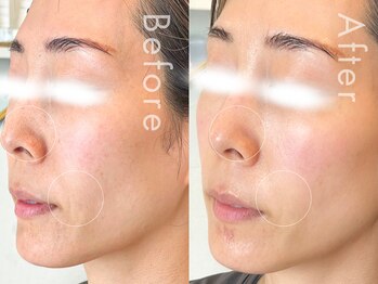 セルフミー 恵比寿(SELF Me...)/ハーブピーリング/くすみ