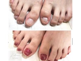フット深爪矯正ワンカラー