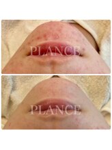 プランス 渋谷(PLANCE)/毛穴/ハーブ/ニキビケア