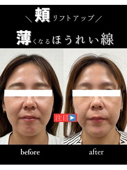 治楽院よう/美容鍼/電気美容鍼