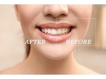 白さ実感できる★黄ばんでいた歯もトーンアップ！