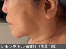 オアシスラグーン(OASIS LAGOON)/レモンボトル（症例1 施術1回）