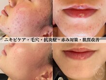 ハーブピーリング 名古屋の雰囲気(7種の天然成分から選べるハーブピーリング♪肌悩みの徹底改善 )