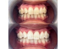 ミレ(mire)/セルフホワイトニング症例写真