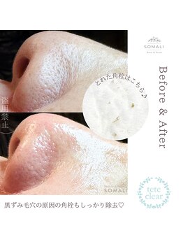 ソマリ(SOMALI)/60代 女性 Before & After