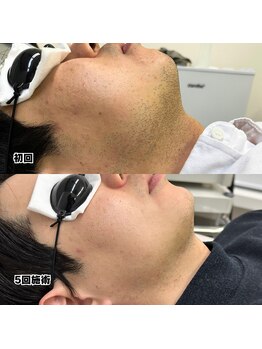 ビビ(BB)/パパで濃いヒゲの方必見！