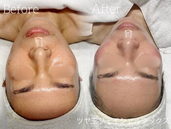 ルチル 八女店(Rutile)/お顔のエステ脱毛