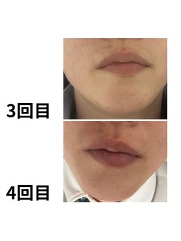 ダンニヒル(dannihil)/ヒゲ脱毛3回目→4回目