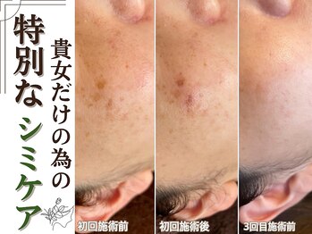 ティーツリー 名古屋 桜山(Tea Tree)/当店のシミケアは