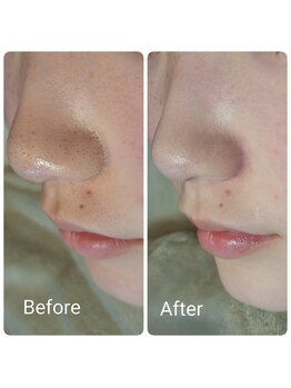 アンレーヴ 津幡店/オイリーな小鼻も毛穴洗浄で解決