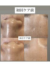 フットミー(foot mii)/ツヤ肌。たるみ毛穴悩みに