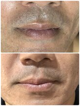 イーネ(ENE)/たった2回でこの効果！ヒゲ脱毛